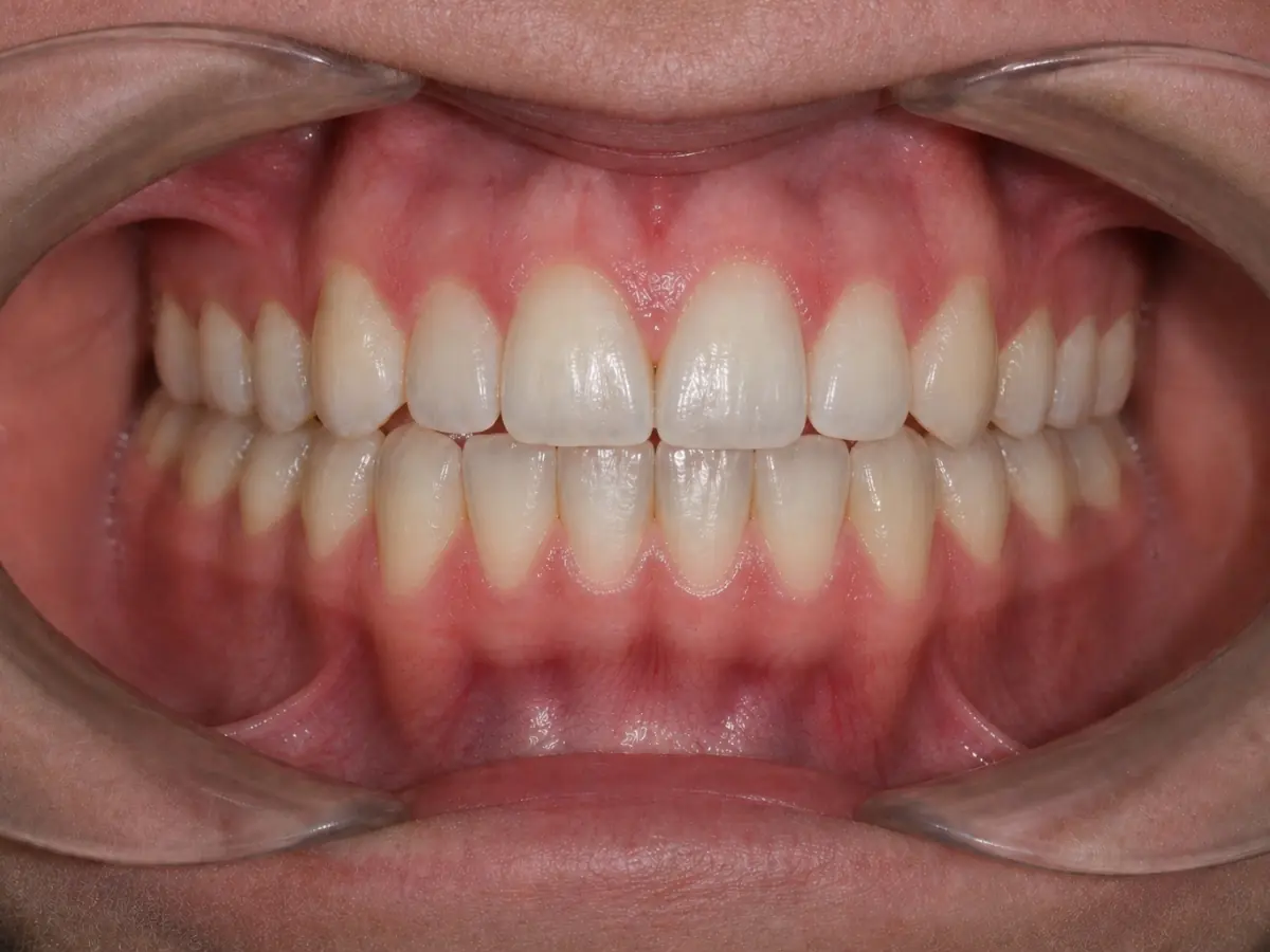 Caso 2 — espacios entre dientes — después