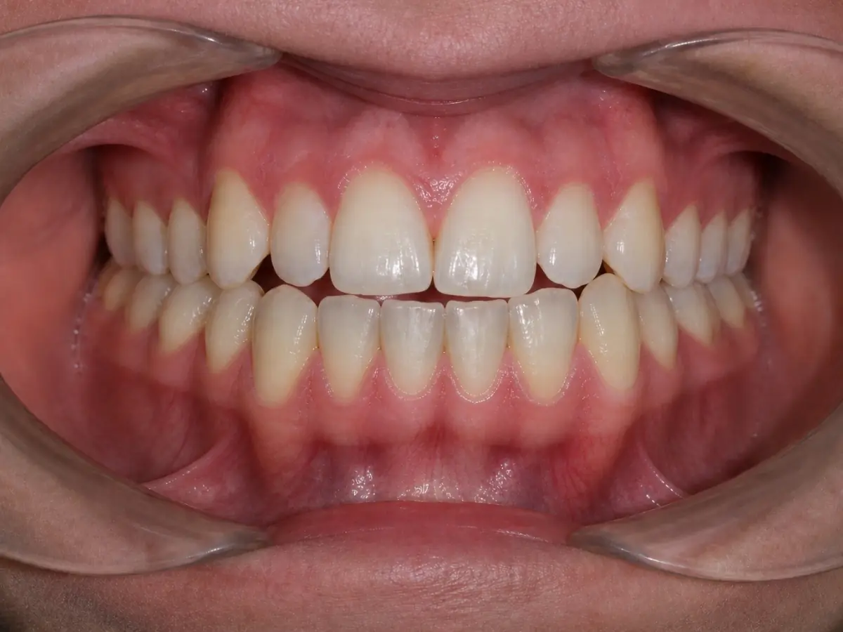 Caso 2 — espacios entre dientes — antes